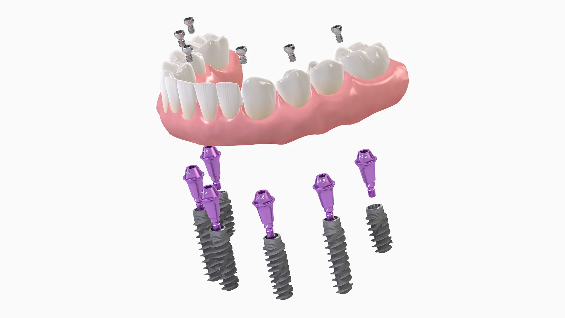 Straumann Proarch 1