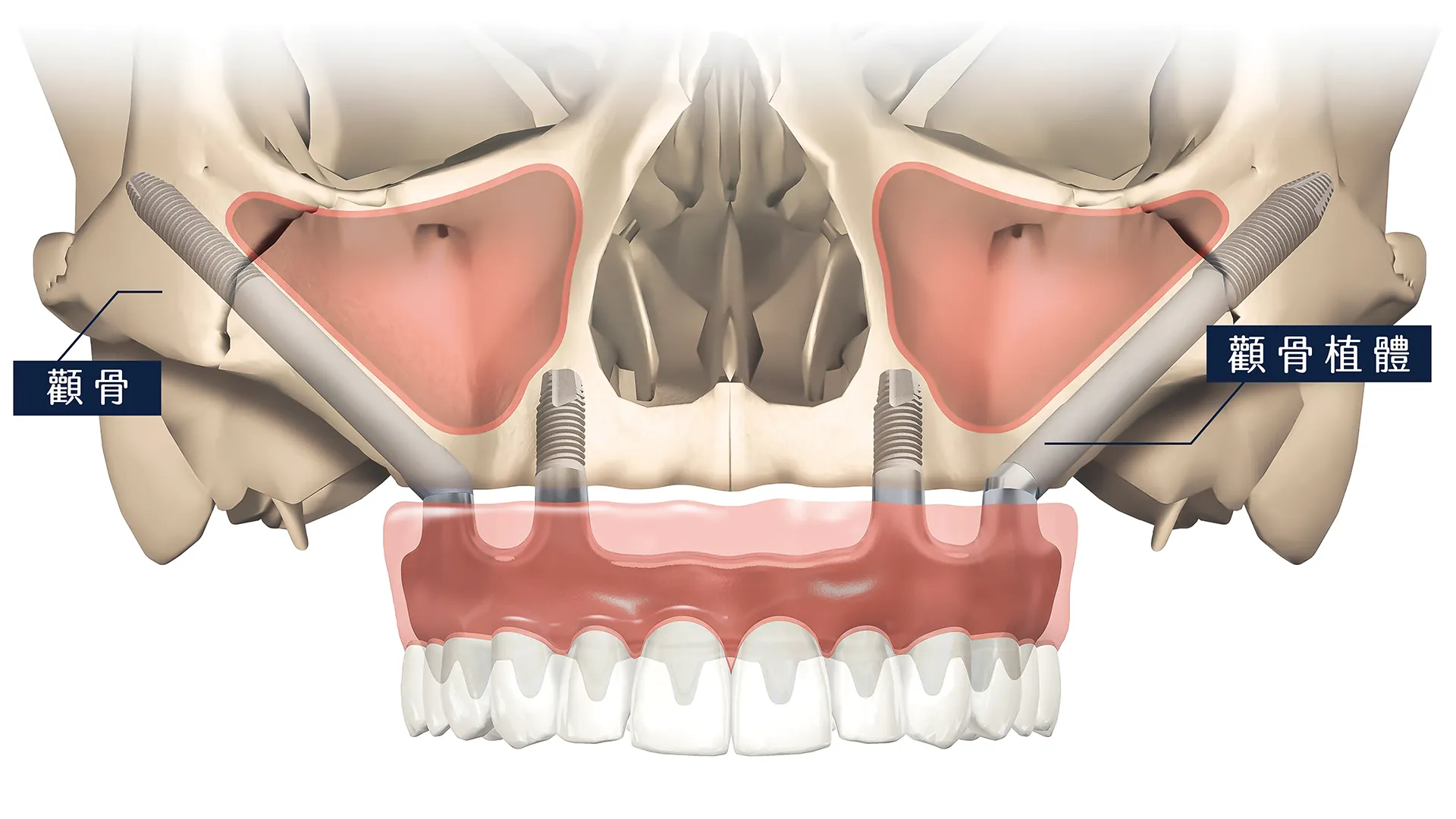 顴骨植牙 New