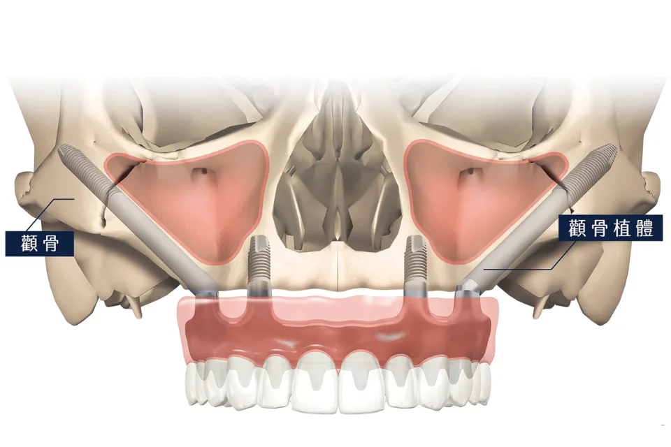 高難度的顴骨植牙，全台不到2%醫師才有的技術！