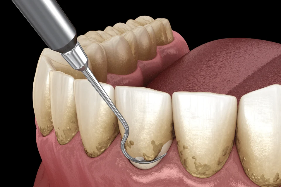 為什麼需要做牙周刮除術？牙醫師帶你快速了解牙周病治療