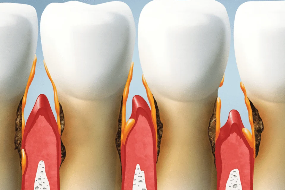 嚴重牙周病的後果可能要開刀！牙周病末期症狀、影響帶你看