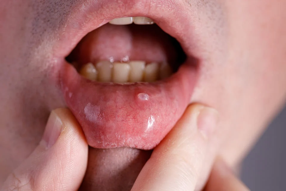 唾液腺囊腫會自己好嗎？唾液腺囊腫看哪一科？常見問題聽聽醫師怎麼說