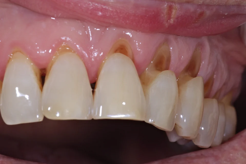 牙根外露怎麼辦?一次看懂6大原因、治療方式