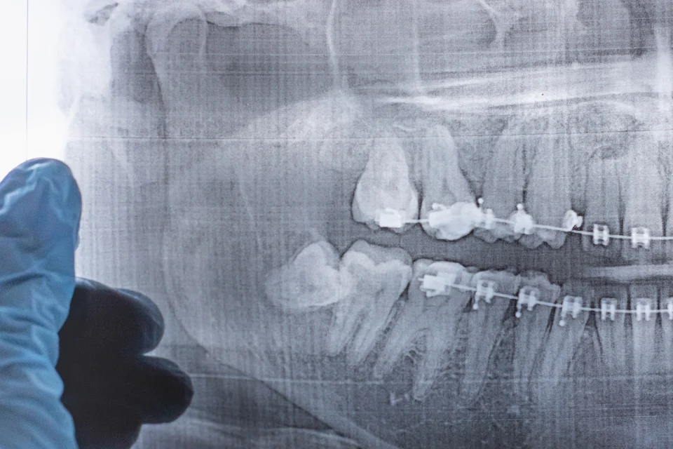 拔智齒要多久？5大因素決定手術時間長短