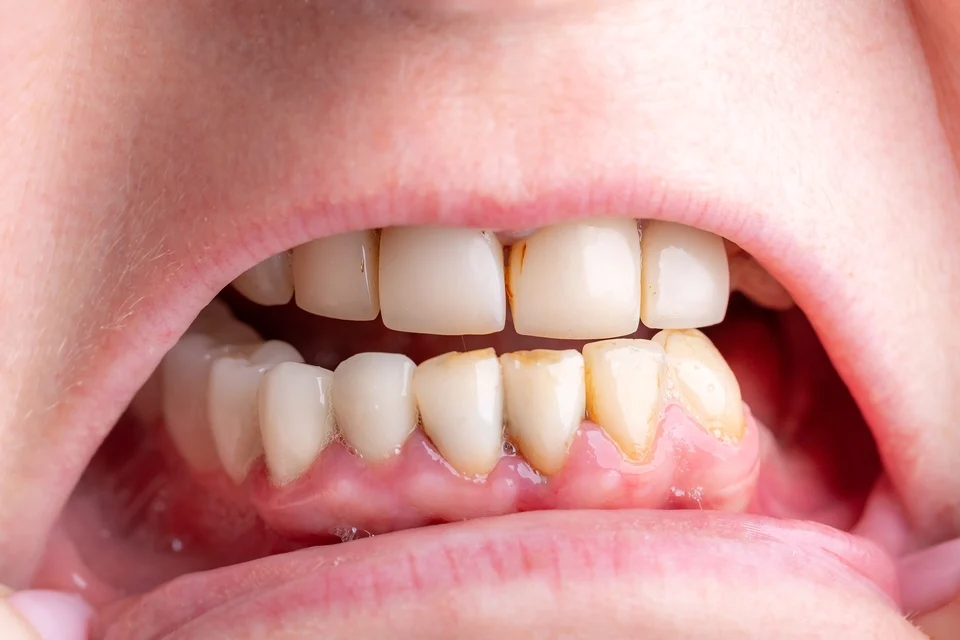 一口爛牙怎麼辦？專業牙醫傳授4個方法，逆轉你的滿口爛牙
