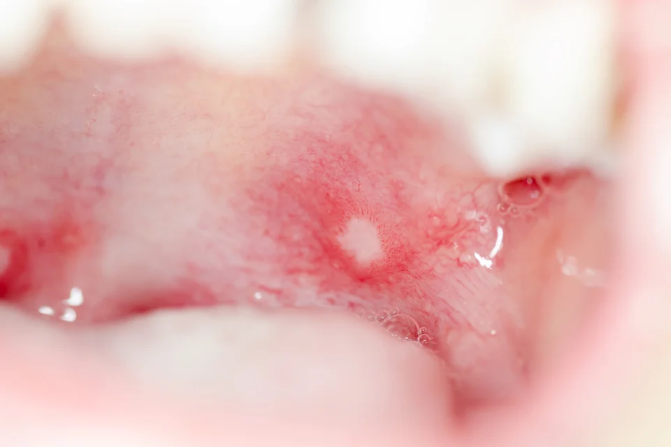 腸病毒嘴破痛到哭？教你4招快速舒緩與正確飲食，大人小孩都適用