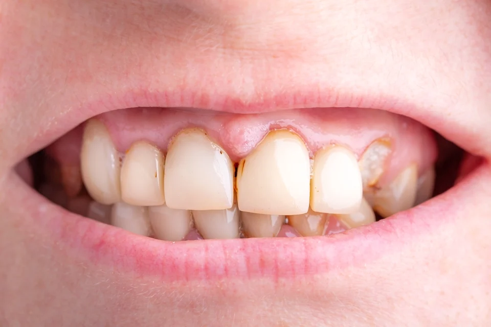 牙周病治療價錢怎麼算？健保自費差異＋省錢方法完整解析