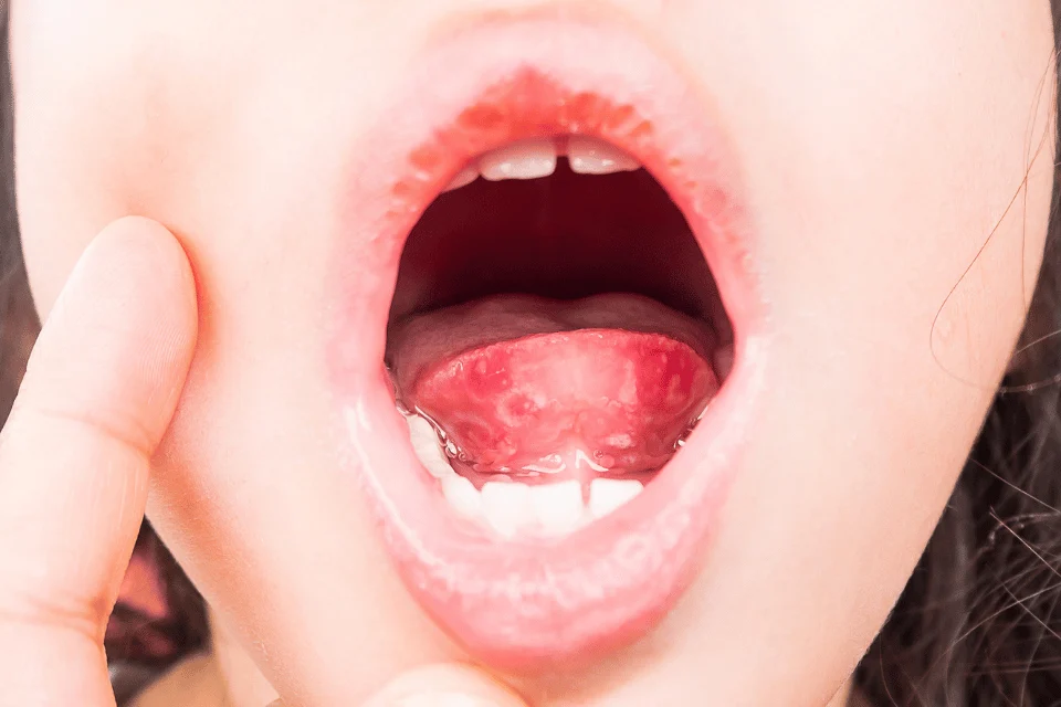 嘴巴破皮不一定是火氣大！牙醫師破解 4 大口腔黏膜脫落原因與舒緩解方