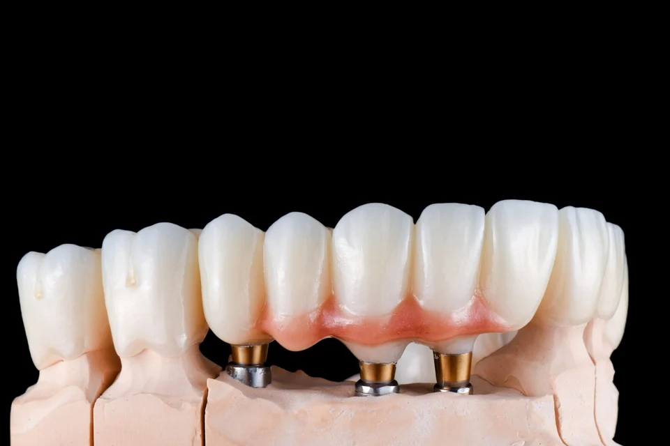 鈕扣式活動假牙費用多少？2026完整費用說明與影響因素