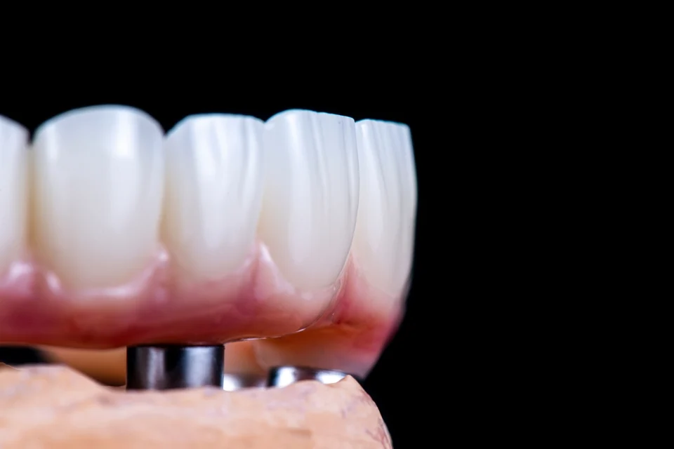 鈕扣式活動假牙缺點有哪些？2026費用、優缺點、適合族群完整說明