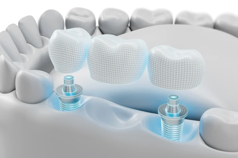 植牙印模會痛嗎？3分鐘帶你搞懂植牙印模流程，拒絕傳統咬模嘔吐感！